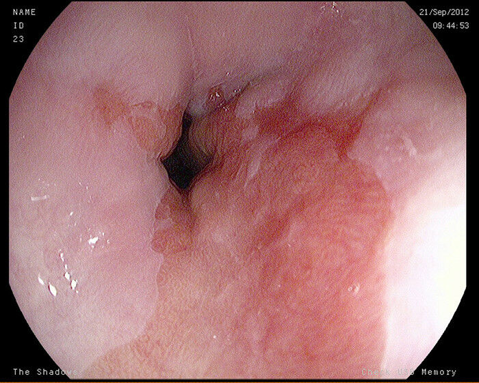 Esta imagem tirada durante uma gastroscopia mostra inflamação do esôfago no