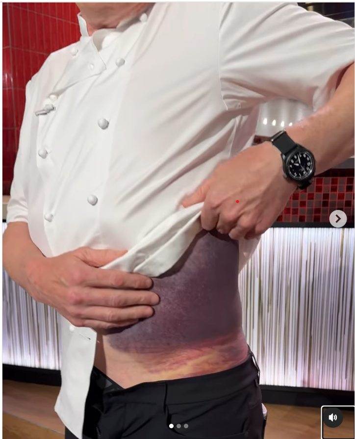 Foto de Gordon Ramsay com um hematoma terrível.