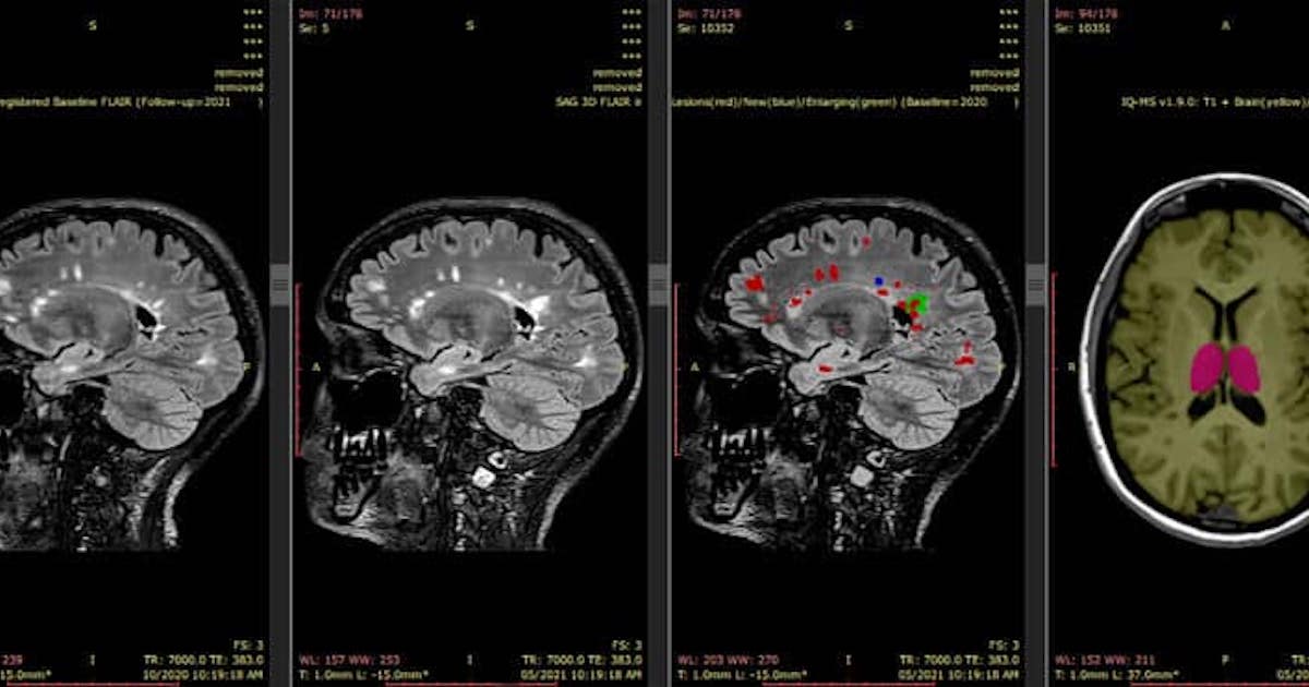 Centro de Análise de Neuroimagem de Sydney recebe bolsa para análise de demência e esclerose múltipla IA