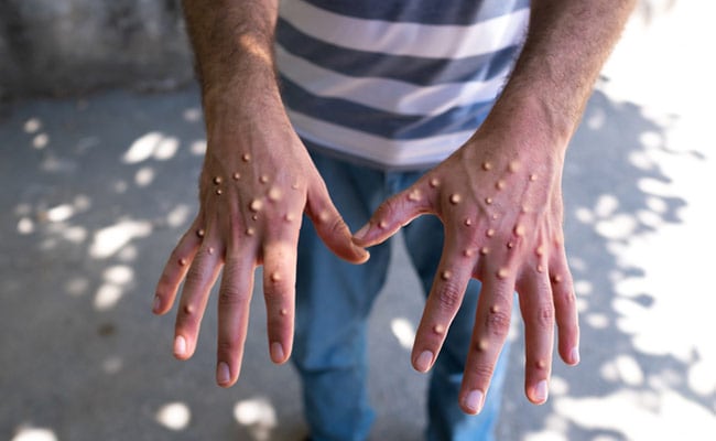 OMS diz que parceiros podem iniciar negociações para comprar vacinas Mpox antes de sua aprovação