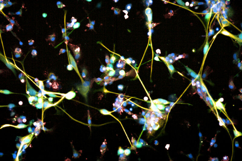 Células de glioblastoma sob o microscópio. (Imagem: Sohyon Lee ÜBerend Snijder ETH