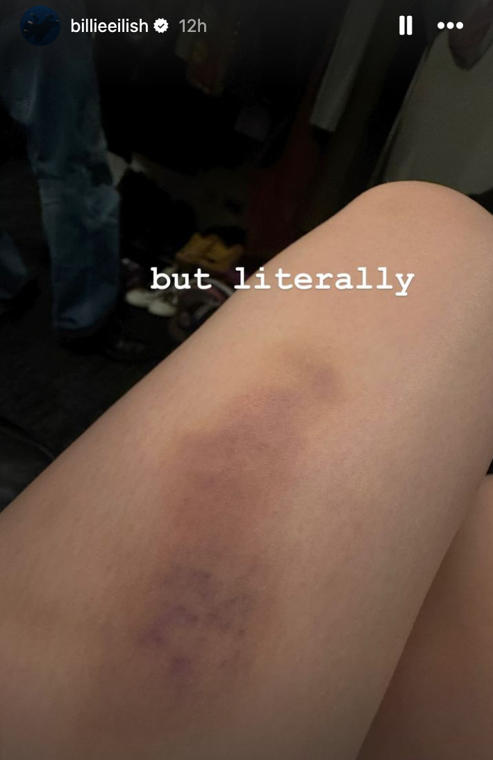 Billie Eilish saiu com um enorme hematoma na perna