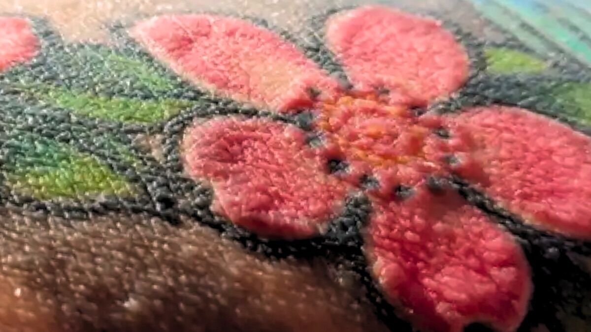 Tatuagens vermelhas desencadearam reações imunitárias chocantes