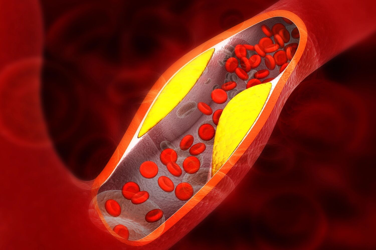 E se o seu corpo já estiver a dar-lhe um aviso? Seis sinais podem revelar colesterol elevado