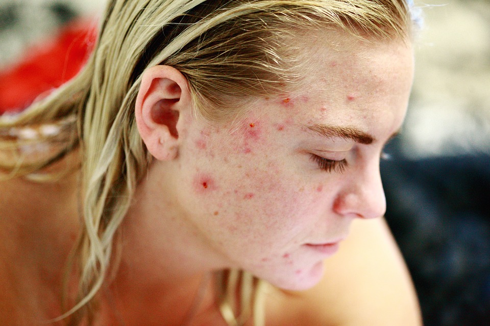 “Bolhas” são a solução perfeita para combater o acne