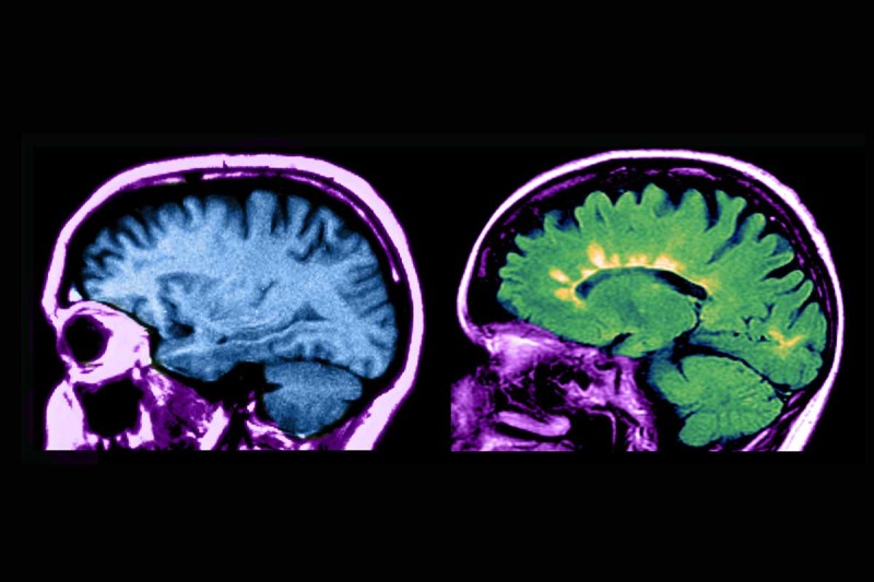 Novo estudo descobre associação entre químicos eternos e esclerose múltipla